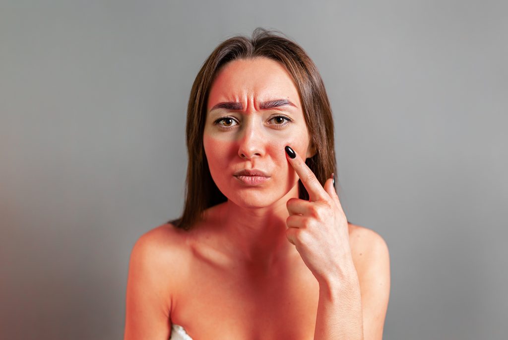 Woman with sunburn
